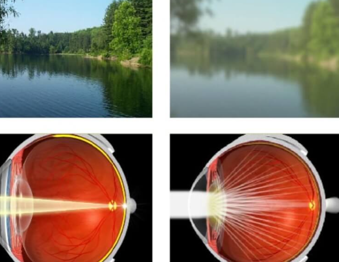 Mengenal Prosedur LASIK
